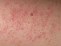 Keratosis Pilaris: Causes, Symptoms, and Treatment