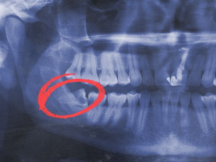 Impacted wisdom teeth: Symptoms and removal
