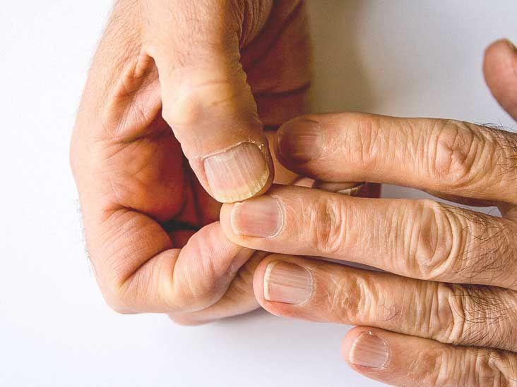 Spoon Nails: Identification, Causes, and More